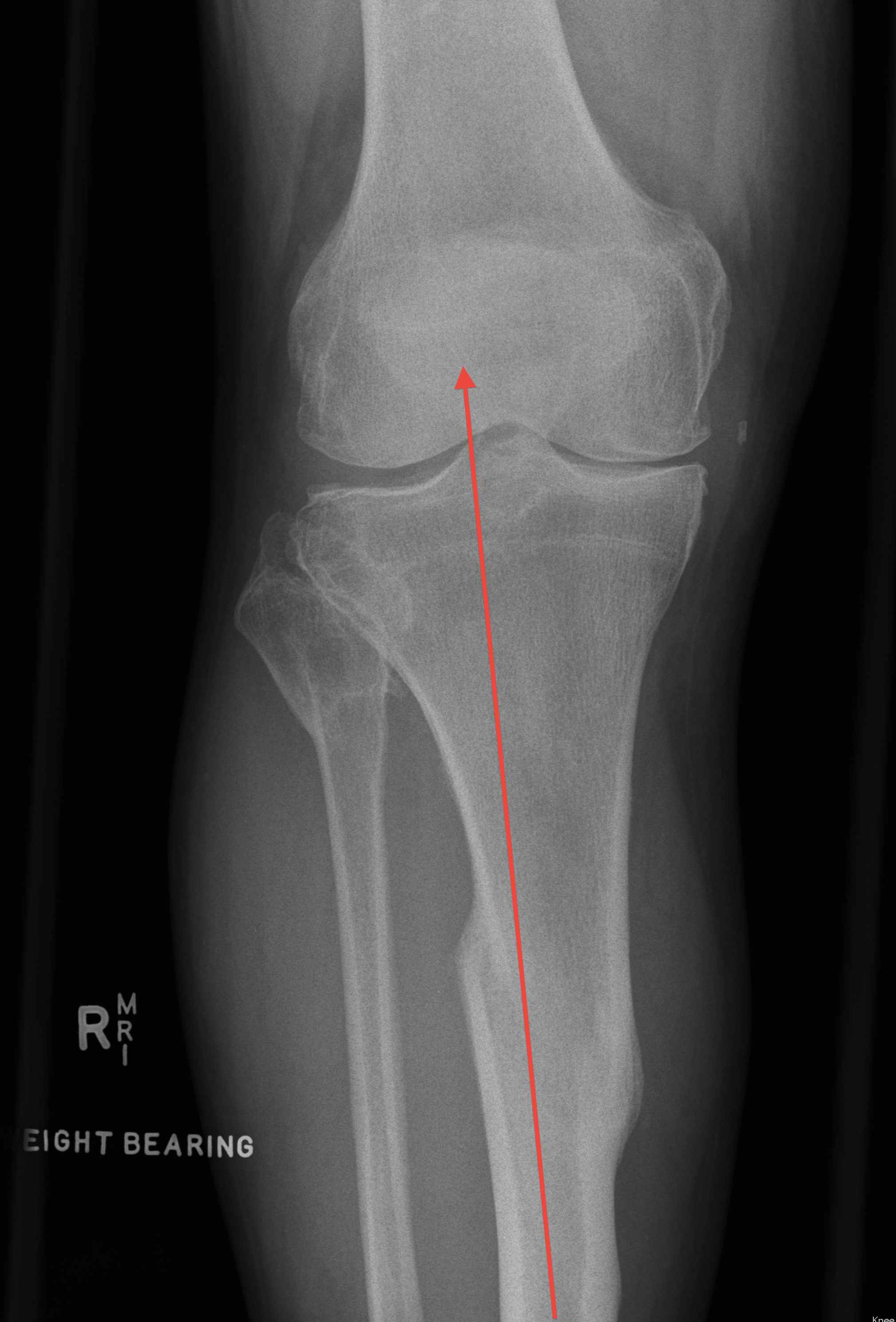 TKR Preop Tibial Deformity